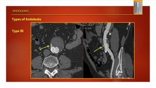 ENDOLEAKS
Types of Endoleaks
Type III
 