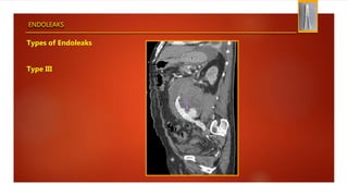 ENDOLEAKS
Types of Endoleaks
Type III
 