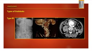 ENDOLEAKS
Types of Endoleaks
Type III
 