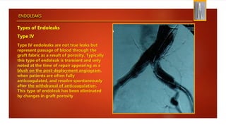 ENDOLEAKS
Types of Endoleaks
Type IV
Type IV endoleaks are not true leaks but
represent passage of blood through the
graft fabric as a result of porosity. Typically
this type of endoleak is transient and only
noted at the time of repair appearing as a
blush on the post-deployment angiogram,
when patients are often fully
anticoagulated, and resolve spontaneously
after the withdrawal of anticoagulation.
This type of endoleak has been eliminated
by changes in graft porosity
 