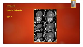 ENDOLEAKS
Types of Endoleaks
Type V
 