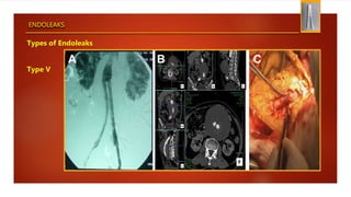 ENDOLEAKS
Types of Endoleaks
Type V
 