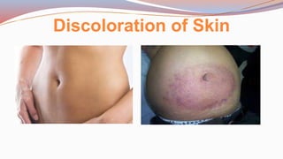 Discoloration of Skin
 