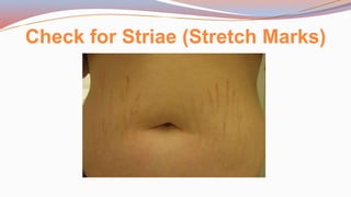 Check for Striae (Stretch Marks)
 