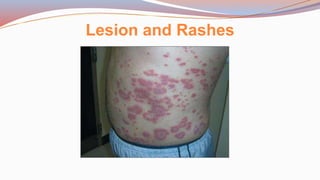 Lesion and Rashes
 