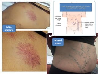 Dilated
Veins
Spider
angioma
 