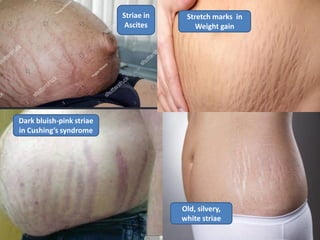Dark bluish-pink striae
in Cushing’s syndrome
Striae in
Ascites
Old, silvery,
white striae
Stretch marks in
Weight gain
 