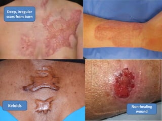 Keloids
Deep, irregular
scars from burn
Non-healing
wound
 