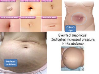 Deviated
umbilicus
Cullen’s
sign
 