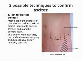 2 possible techniques to confirm
ascites:
 1. Test for shifting
dullness.
 After mapping the borders of
tympany and dullness, ask the
patient to turn onto one side.
 Percuss and mark the
borders again.
 In a person without ascites,
the borders between tympany
and dullness usually stay
relatively constant.
 