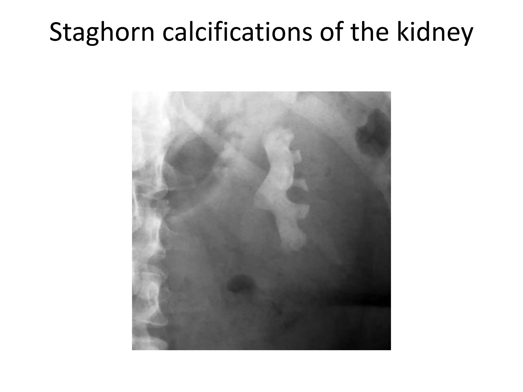 ABDOMINAL CALCIFICATIONS.pptx