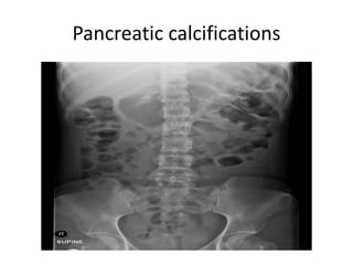 ABDOMINAL CALCIFICATIONS.pptx