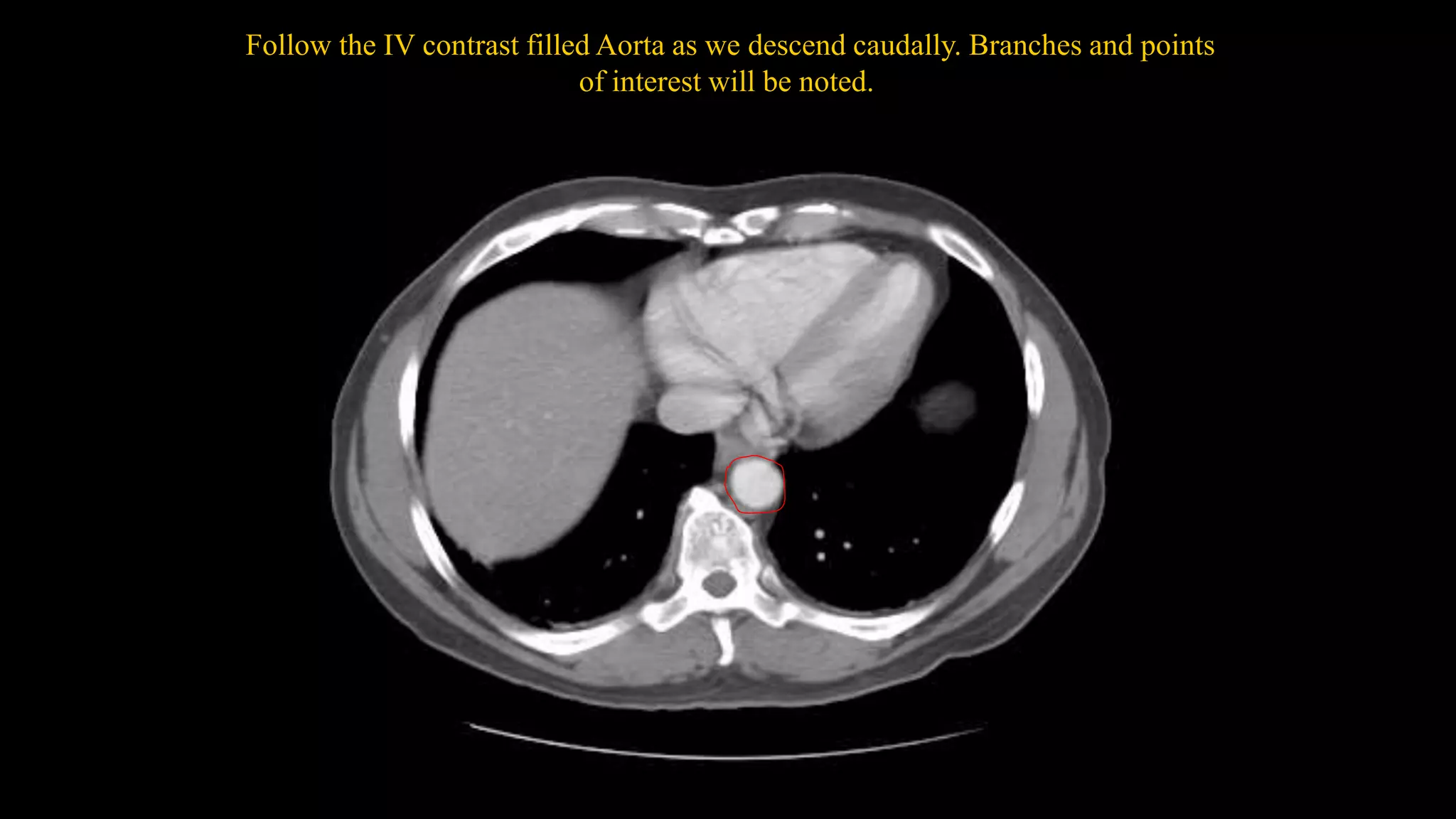 Follow the IV contrast filled Aorta as we descend caudally. Branches and points
of interest will be noted.
 