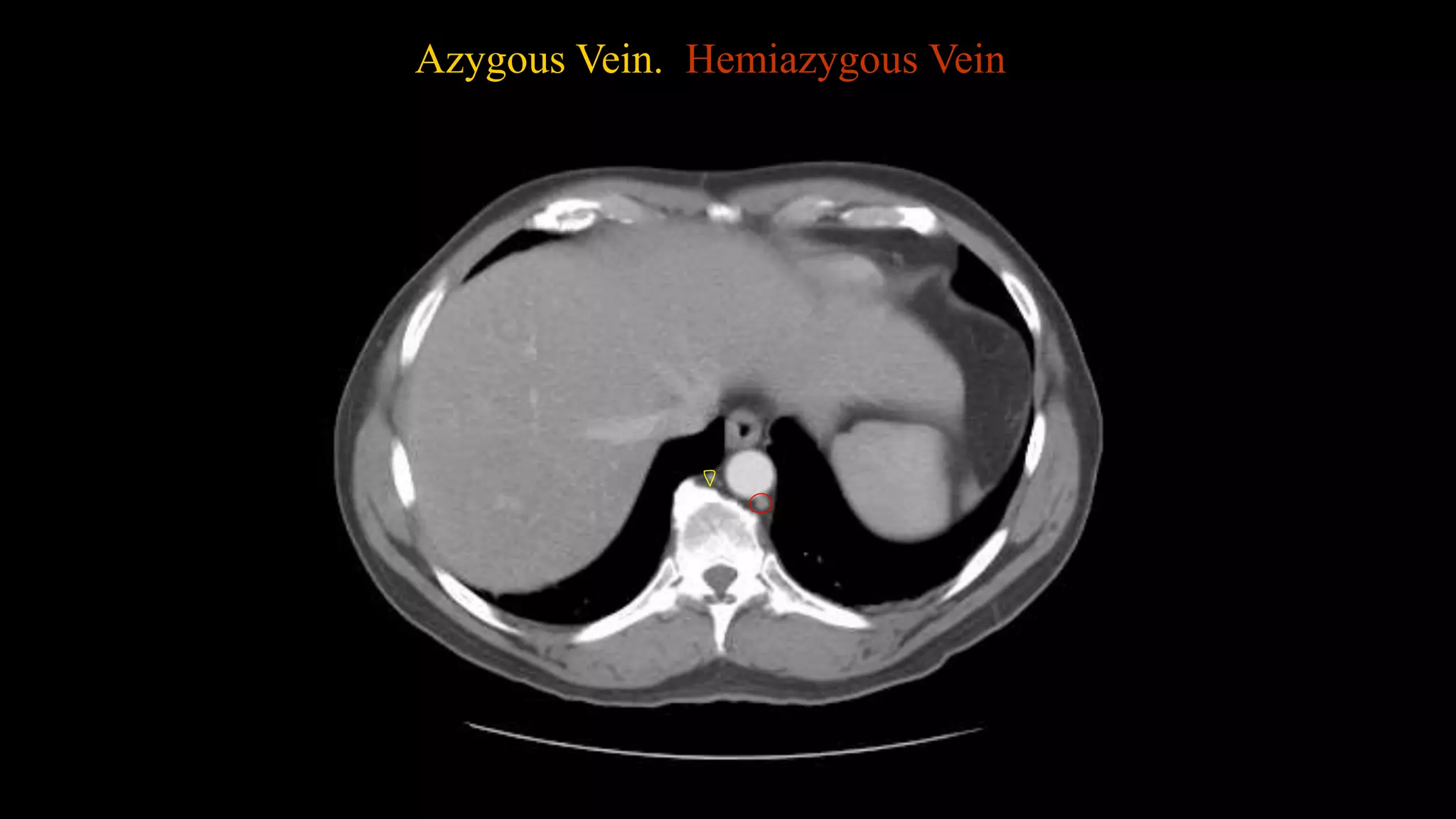 Azygous Vein. Hemiazygous Vein
 