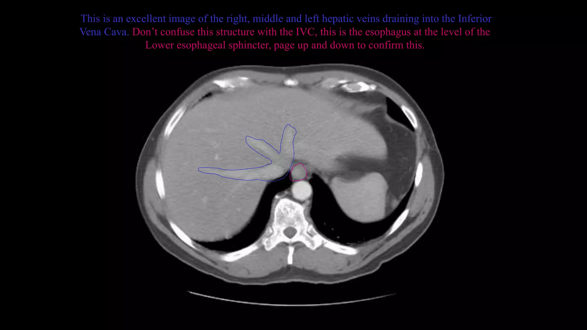 This is an excellent image of the right, middle and left hepatic veins draining into the Inferior
Vena Cava. Don’t confuse this structure with the IVC, this is the esophagus at the level of the
Lower esophageal sphincter, page up and down to confirm this.
 