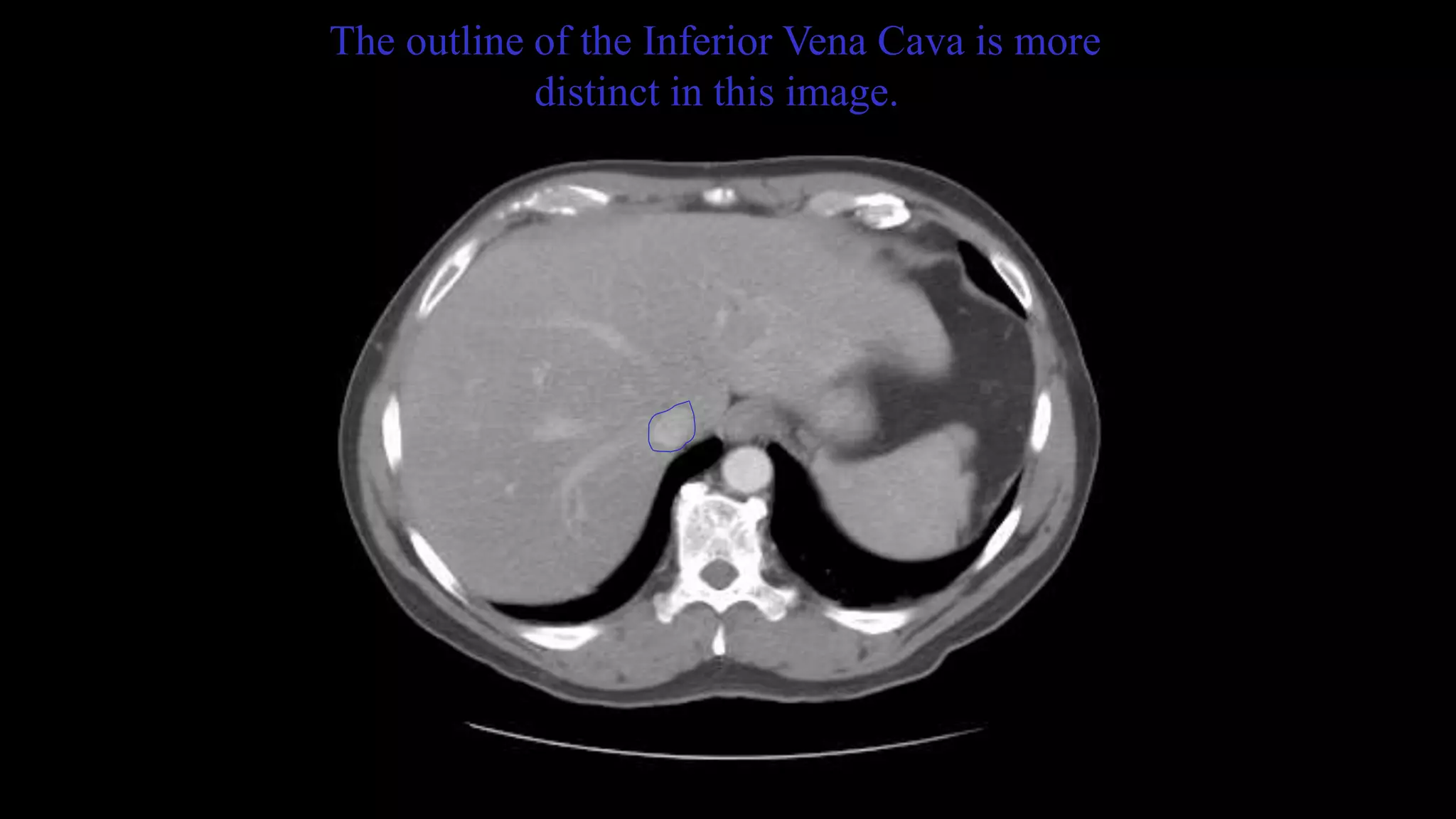 The outline of the Inferior Vena Cava is more
distinct in this image.
 