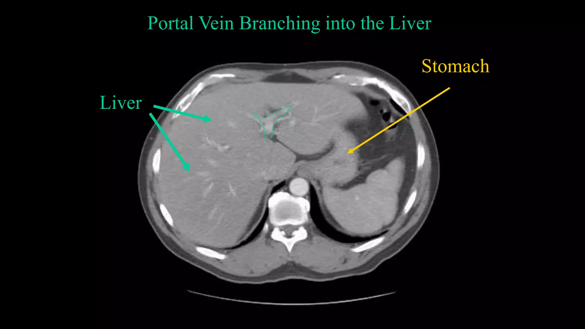 Portal Vein Branching into the Liver
Liver
Stomach
 