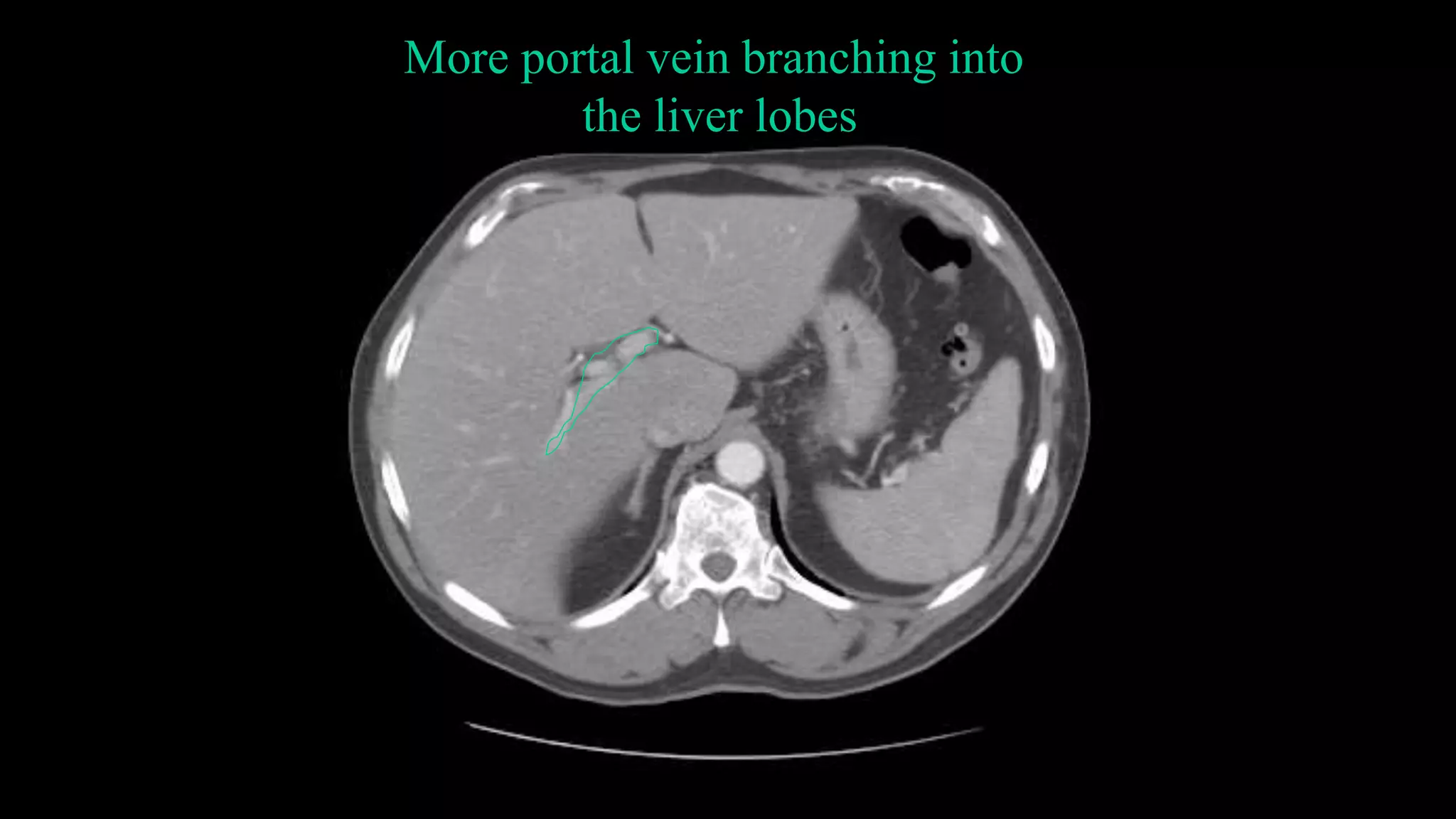 More portal vein branching into
the liver lobes
 