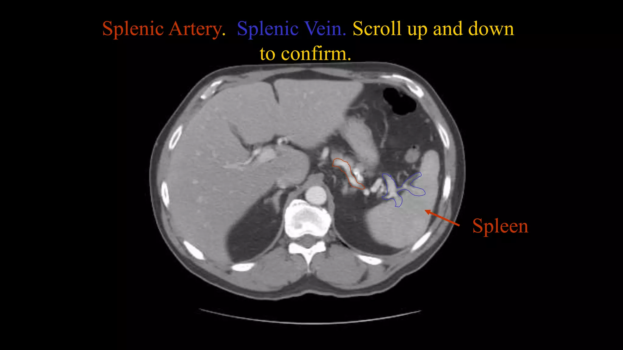 Splenic Artery. Splenic Vein. Scroll up and down
to confirm.
Spleen
 
