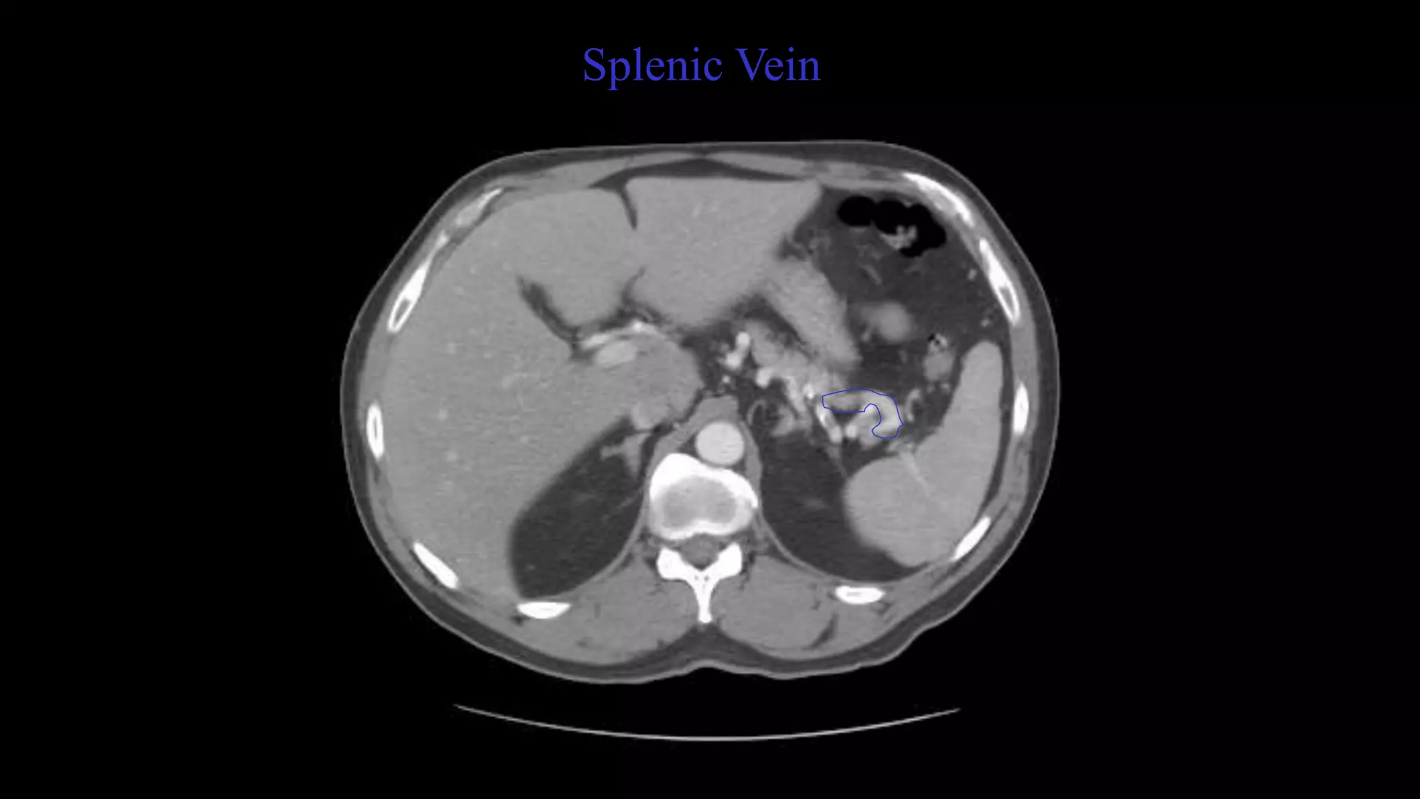 Splenic Vein
 