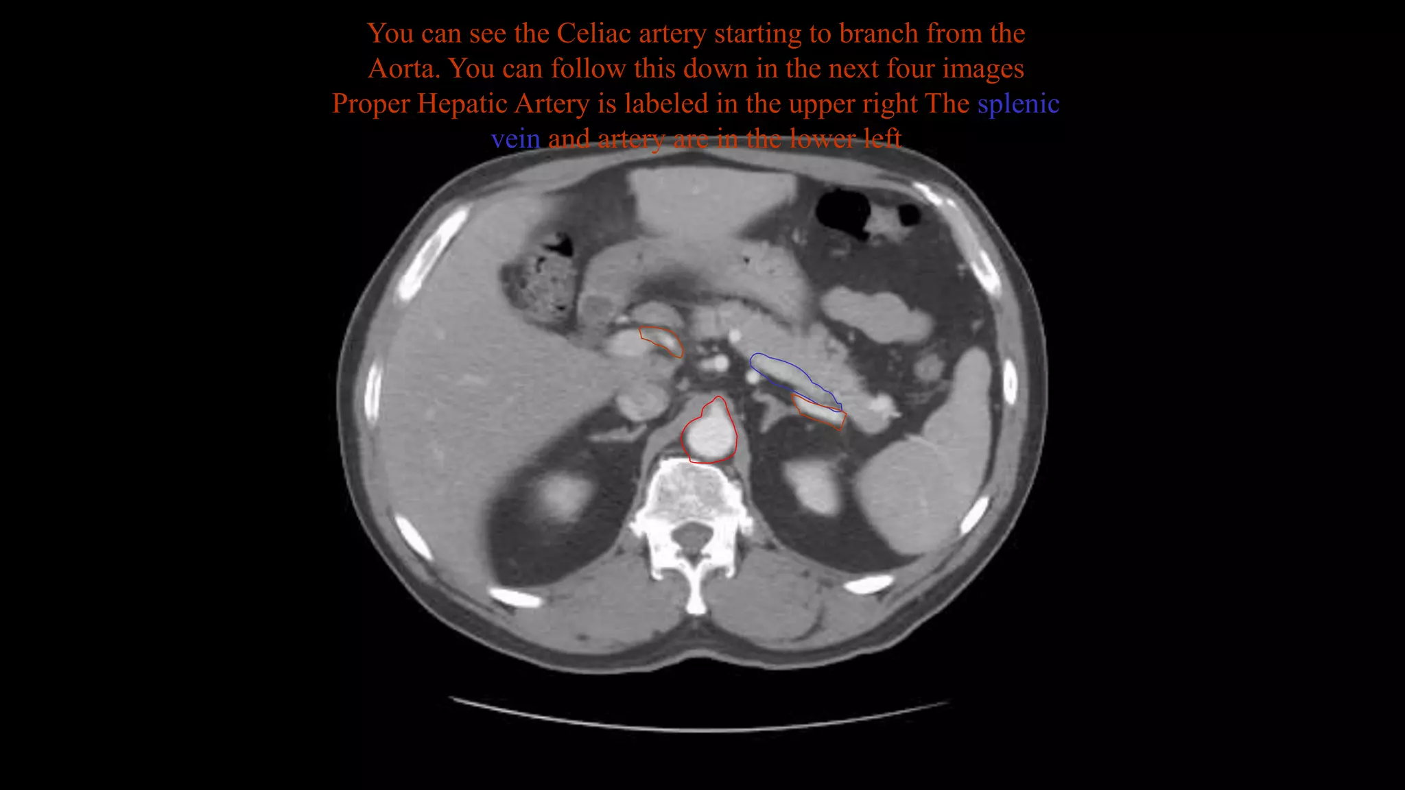 You can see the Celiac artery starting to branch from the
Aorta. You can follow this down in the next four images
Proper Hepatic Artery is labeled in the upper right The splenic
vein and artery are in the lower left
 