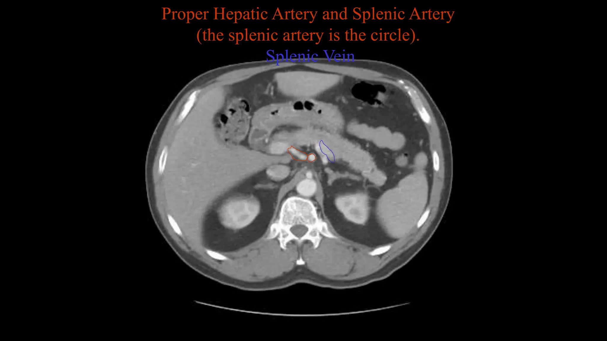 Proper Hepatic Artery and Splenic Artery
(the splenic artery is the circle).
Splenic Vein
 