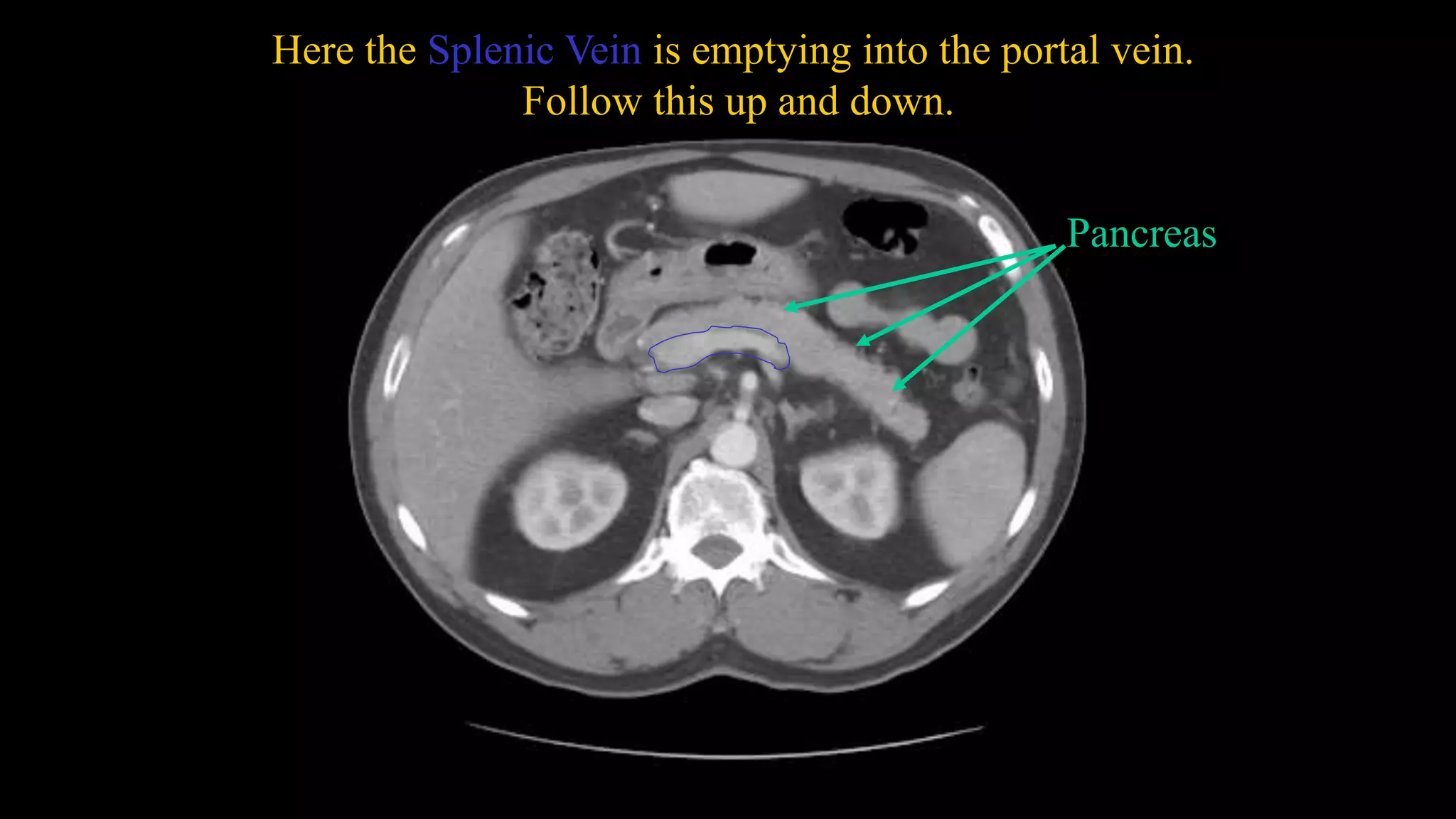 Here the Splenic Vein is emptying into the portal vein.
Follow this up and down.
Pancreas
 