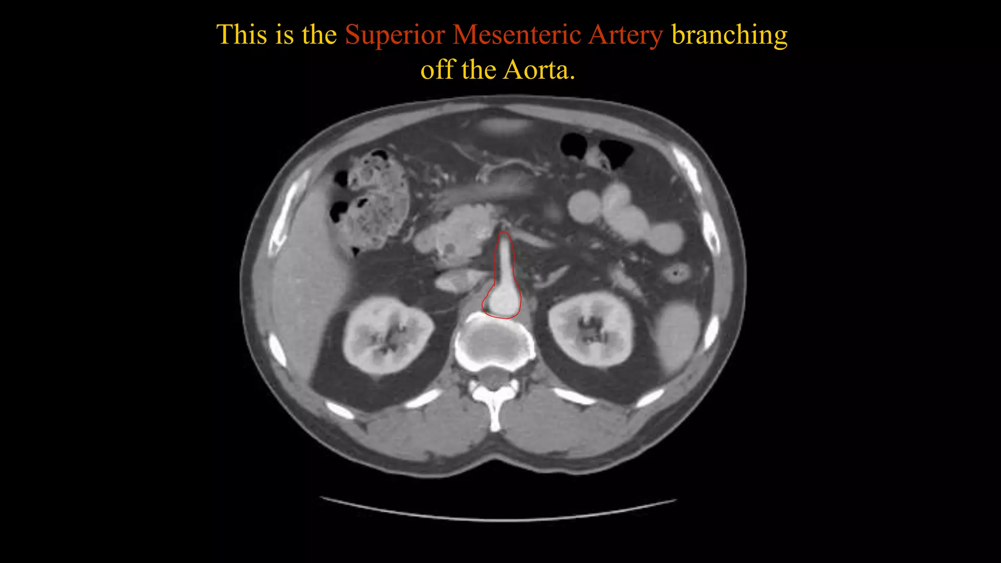 This is the Superior Mesenteric Artery branching
off the Aorta.
 