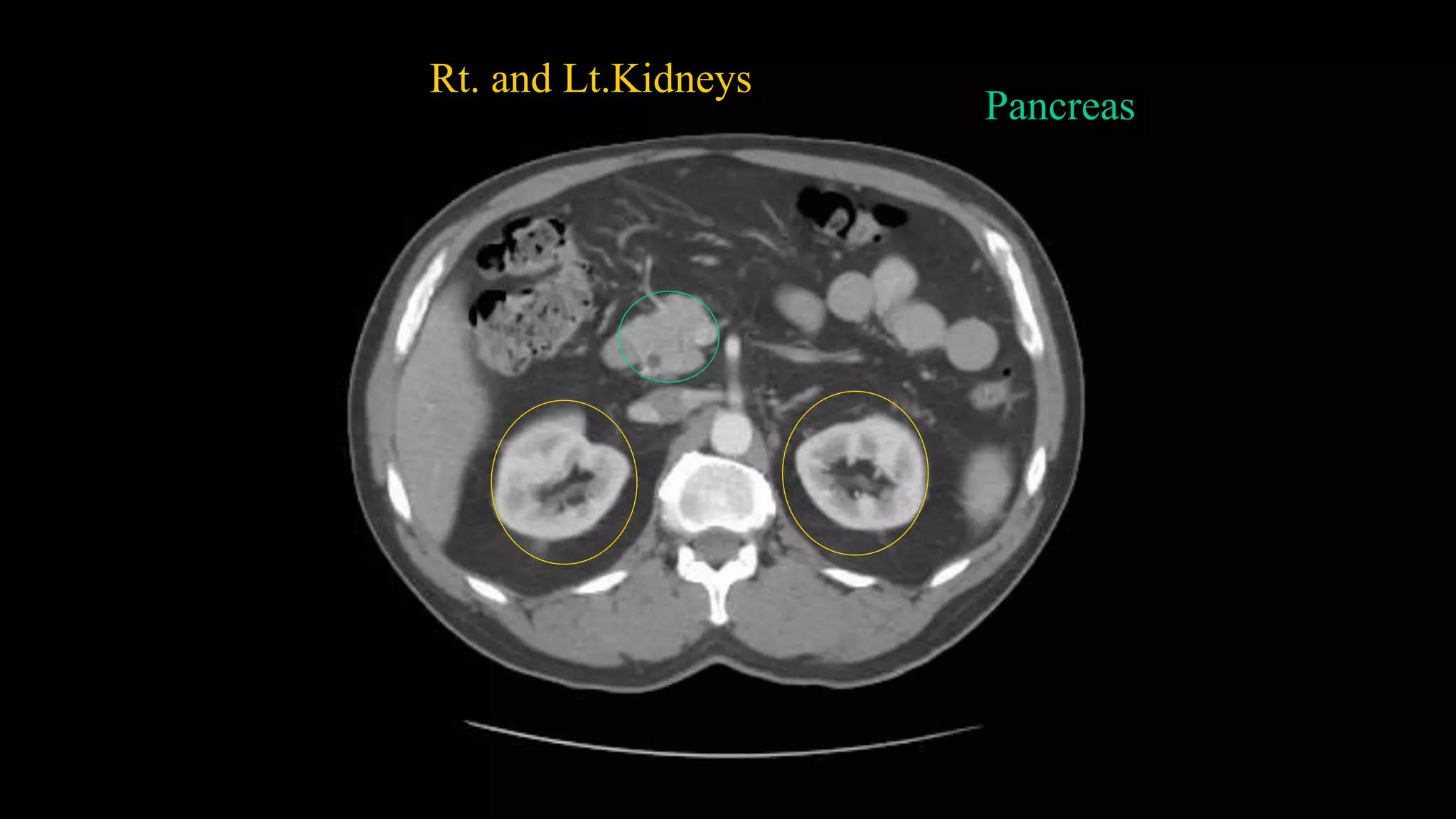 Rt. and Lt.Kidneys
Pancreas
 