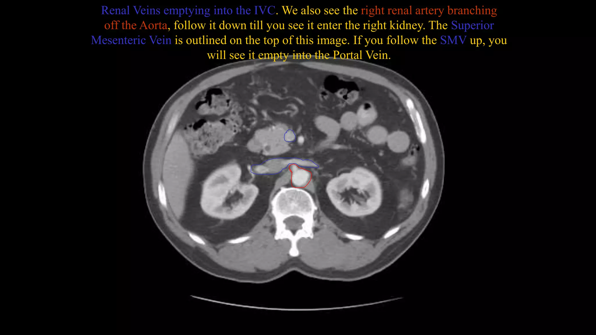 Renal Veins emptying into the IVC. We also see the right renal artery branching
off the Aorta, follow it down till you see it enter the right kidney. The Superior
Mesenteric Vein is outlined on the top of this image. If you follow the SMV up, you
will see it empty into the Portal Vein.
 