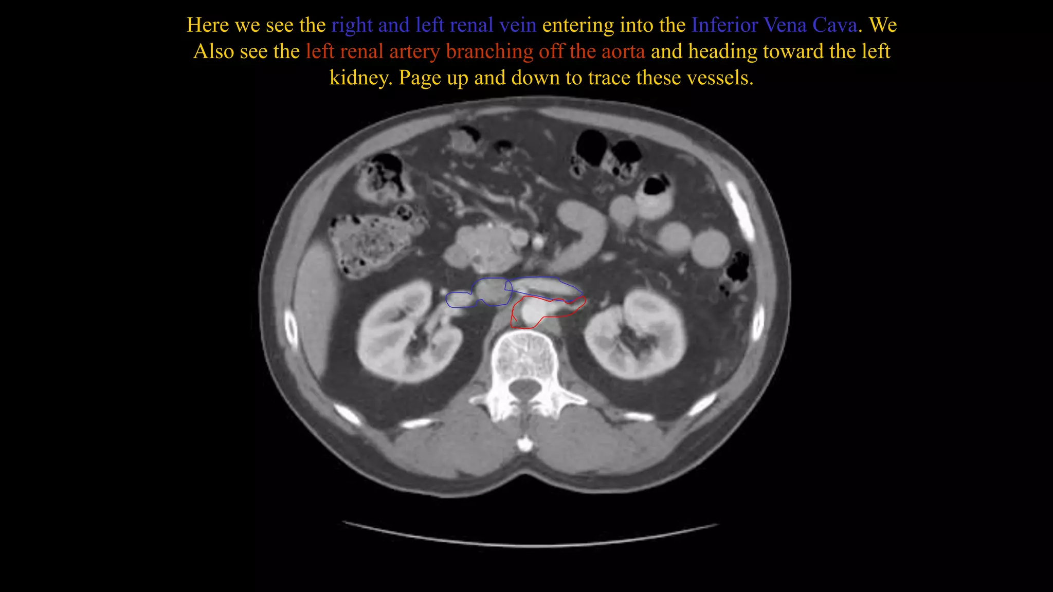 Here we see the right and left renal vein entering into the Inferior Vena Cava. We
Also see the left renal artery branching off the aorta and heading toward the left
kidney. Page up and down to trace these vessels.
 