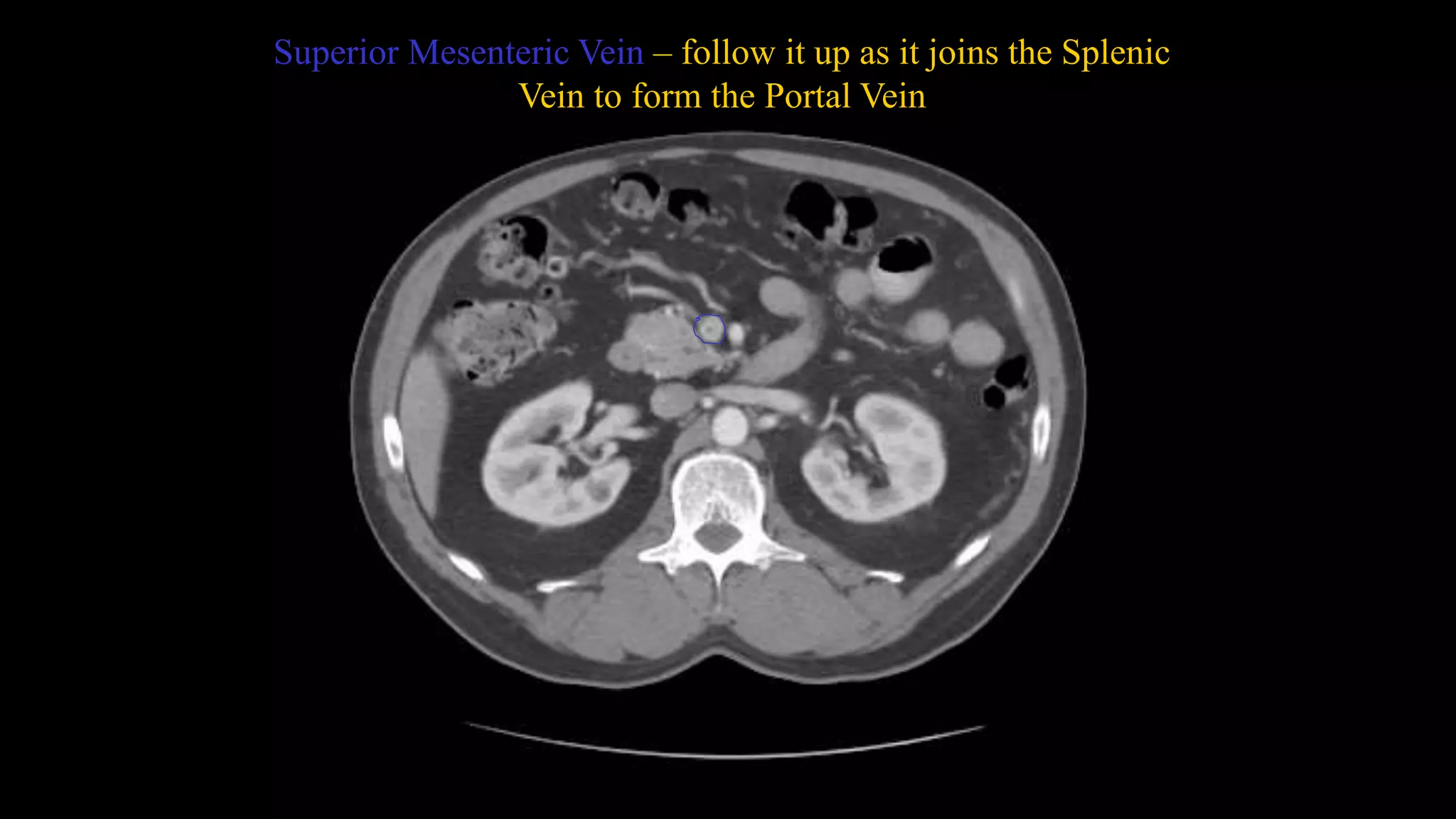 Superior Mesenteric Vein – follow it up as it joins the Splenic
Vein to form the Portal Vein
 