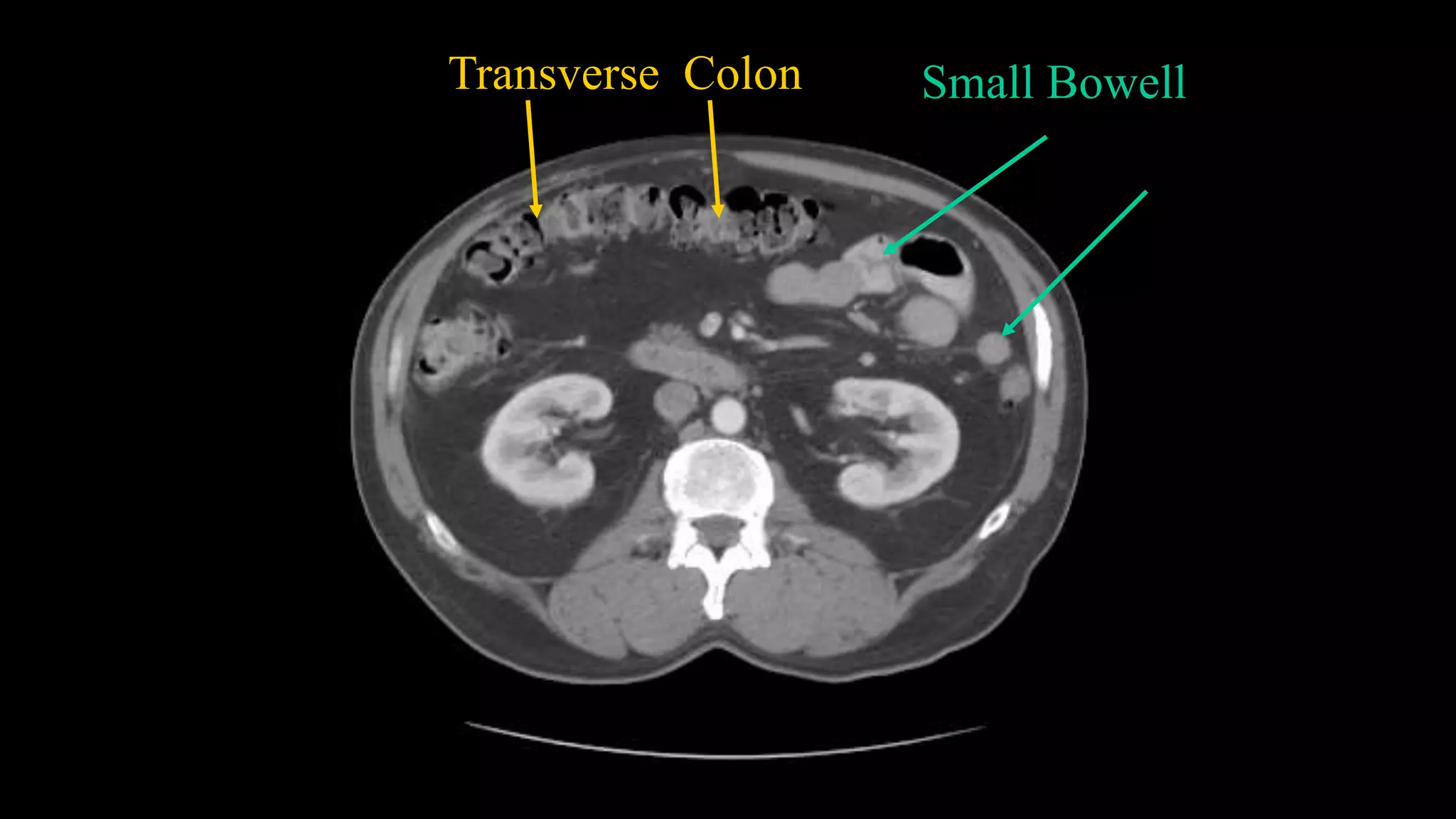 Transverse Colon Small Bowell
 