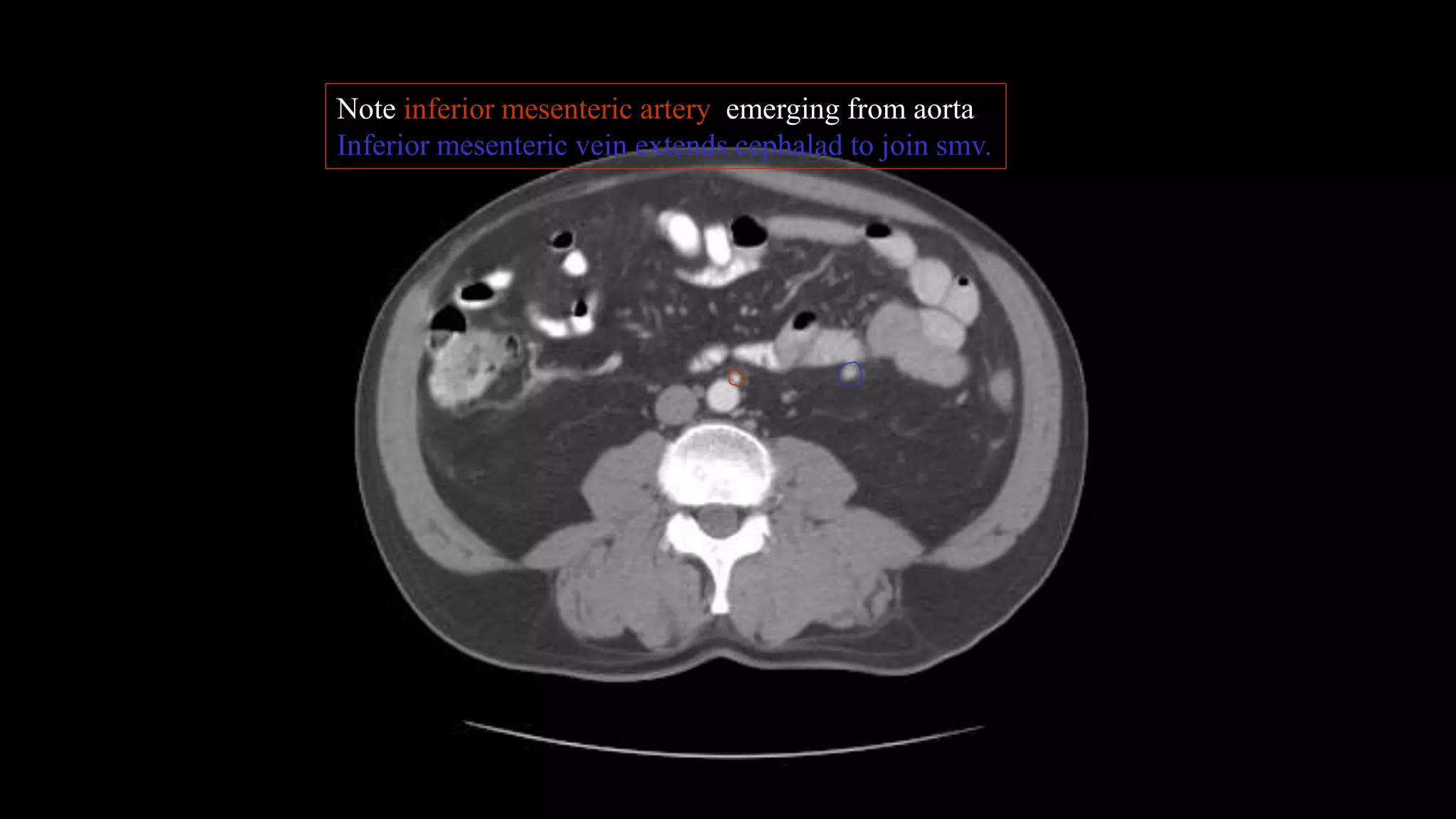 Note inferior mesenteric artery emerging from aorta
Inferior mesenteric vein extends cephalad to join smv.
 