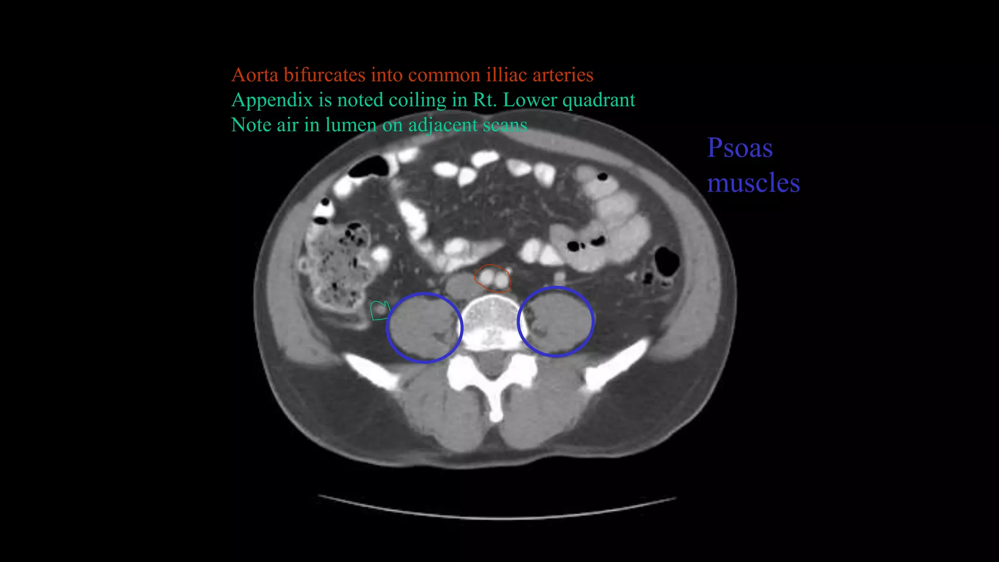 Aorta bifurcates into common illiac arteries
Appendix is noted coiling in Rt. Lower quadrant
Note air in lumen on adjacent scans
Psoas
muscles
 