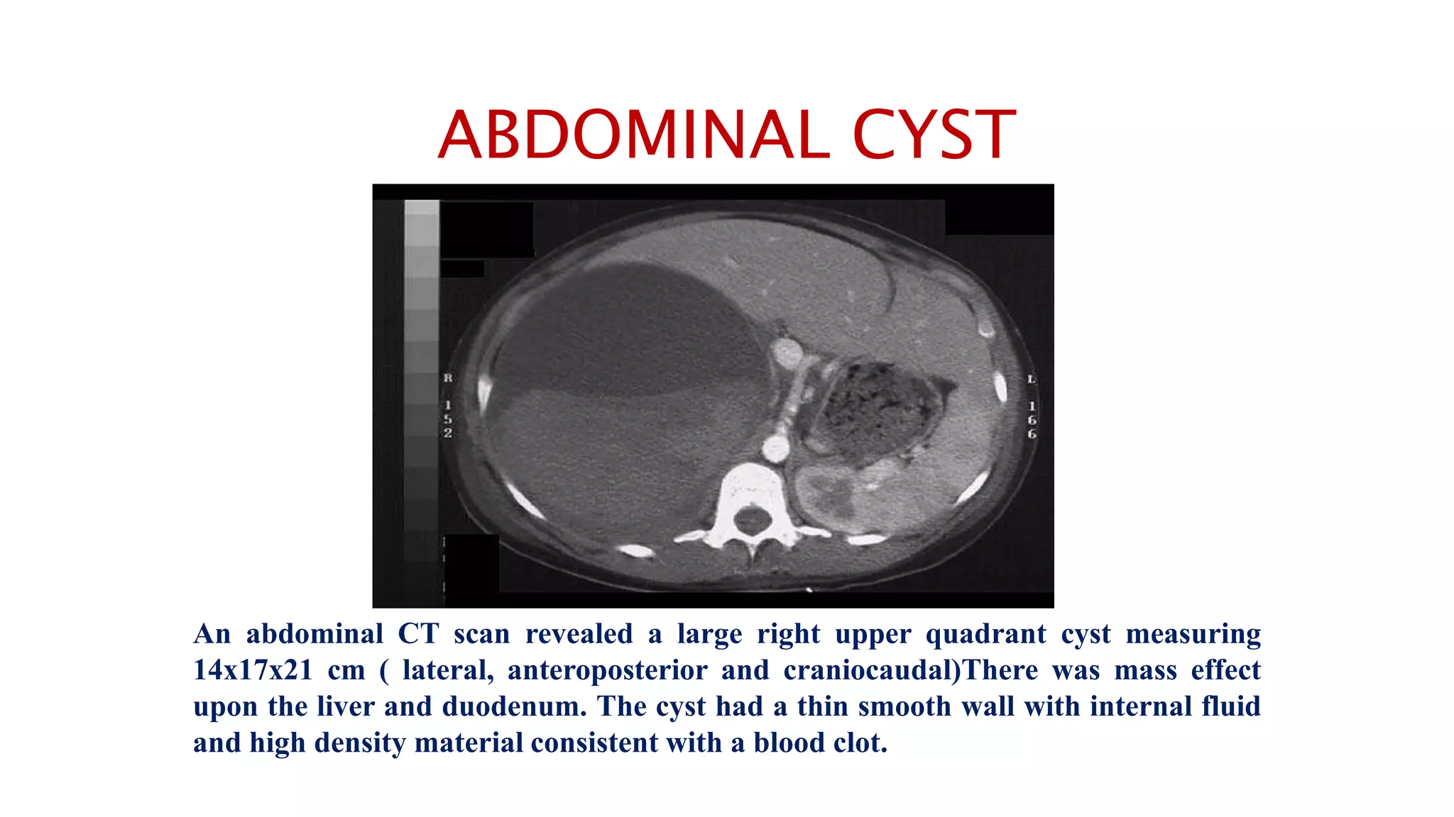ABDOMINAL CYST
An abdominal CT scan revealed a large right upper quadrant cyst measuring
14x17x21 cm ( lateral, anteroposterior and craniocaudal)There was mass effect
upon the liver and duodenum. The cyst had a thin smooth wall with internal fluid
and high density material consistent with a blood clot.
 