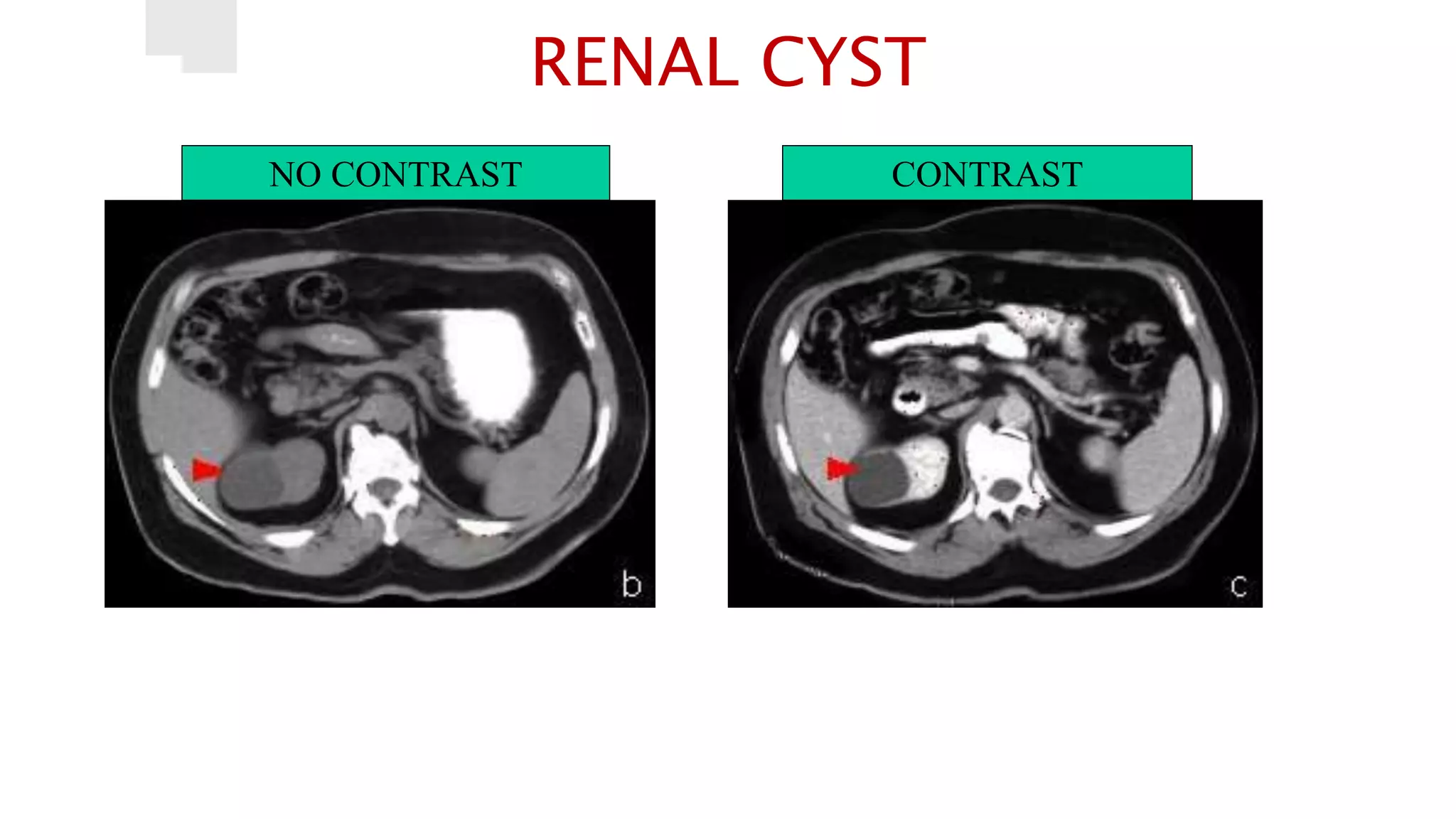 RENAL CYST
NO CONTRAST CONTRAST
 