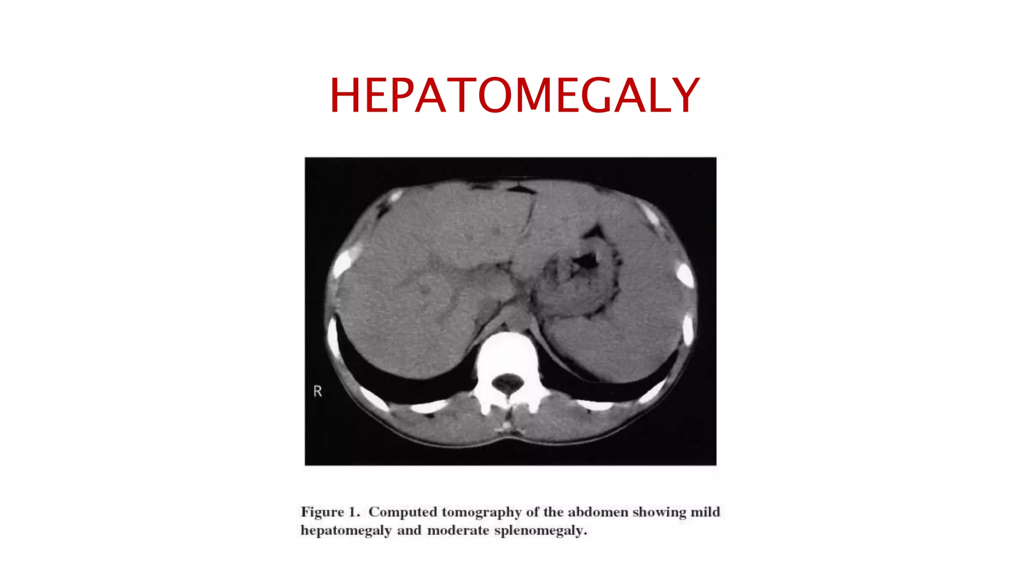 HEPATOMEGALY
 