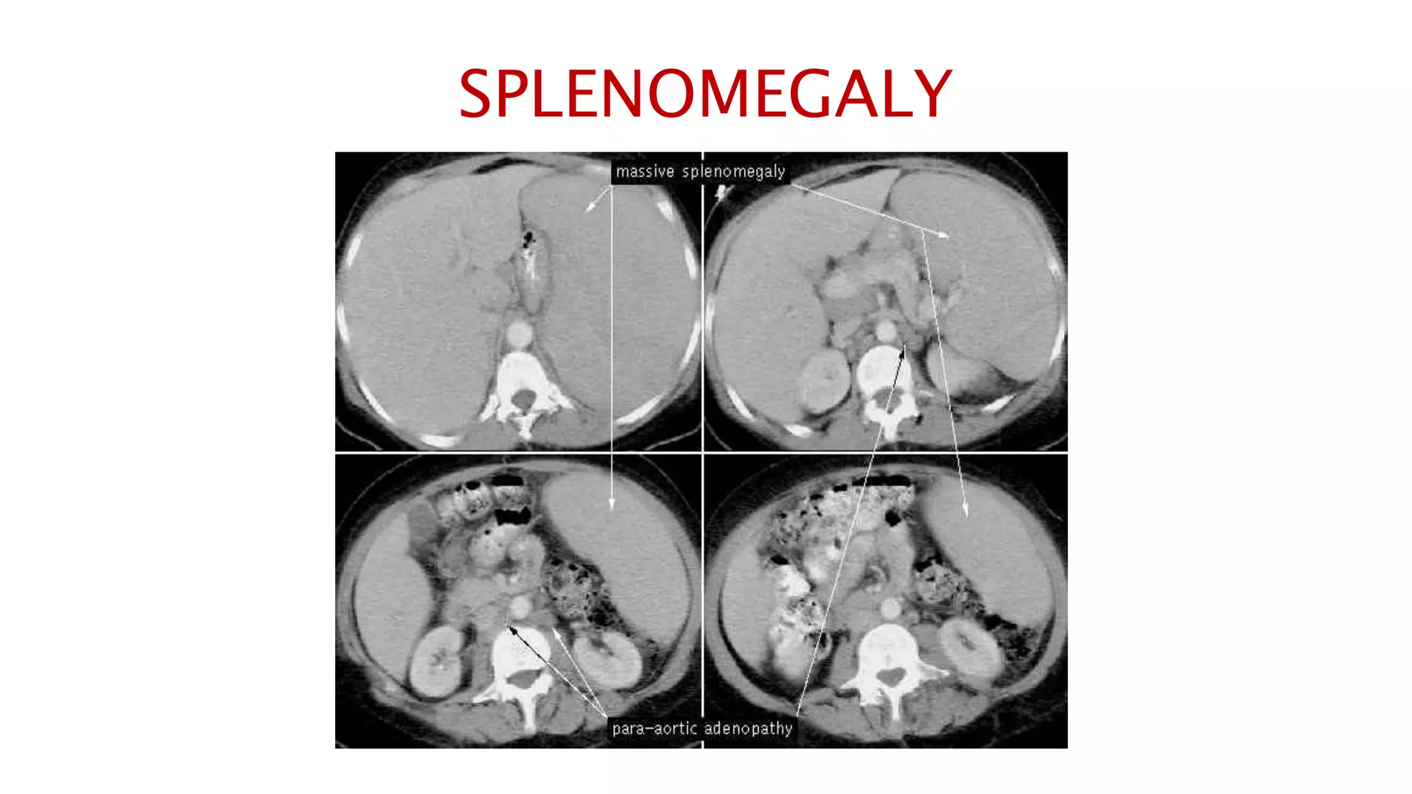 SPLENOMEGALY
 