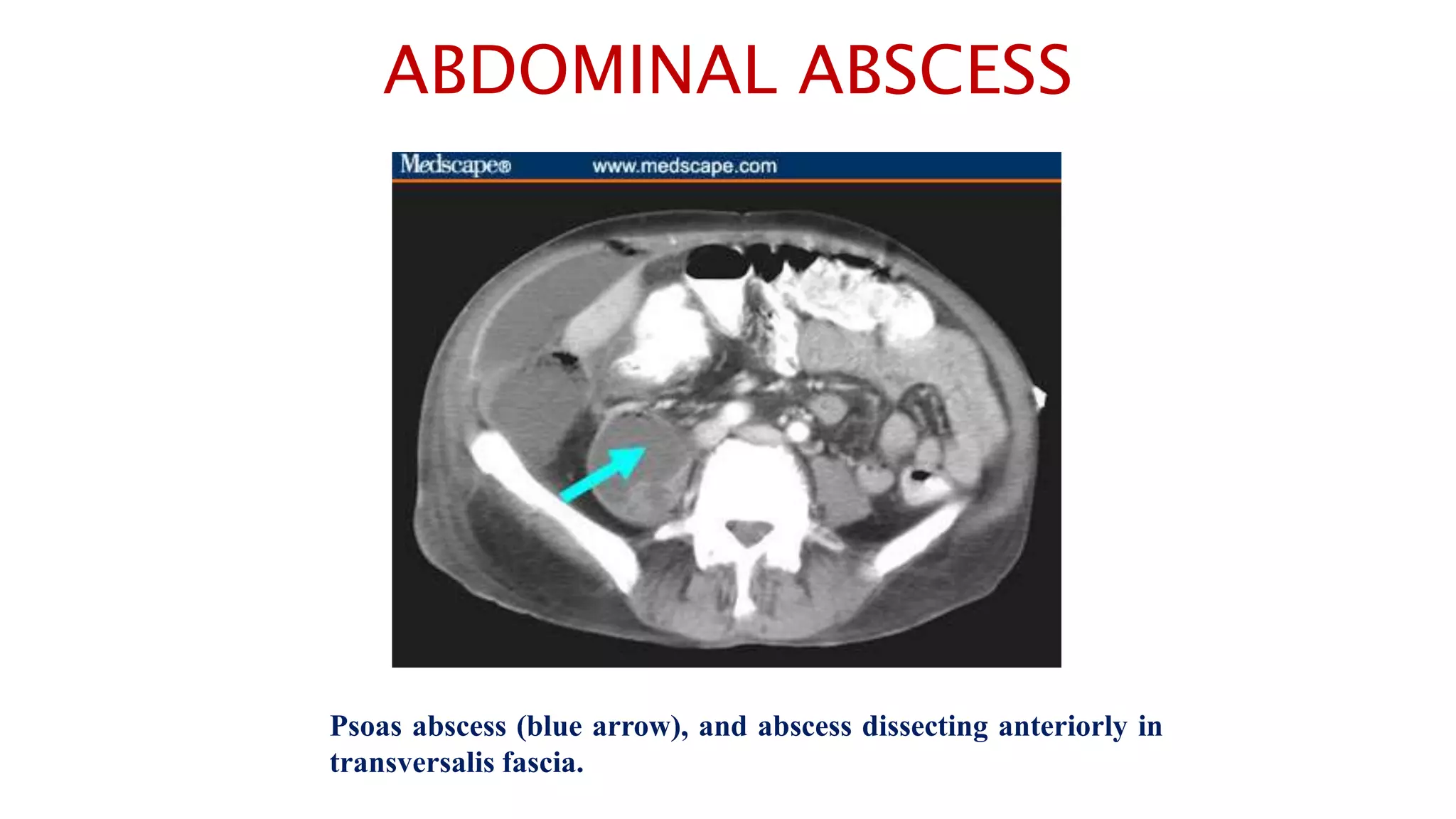 ABDOMINAL ABSCESS
Psoas abscess (blue arrow), and abscess dissecting anteriorly in
transversalis fascia.
 