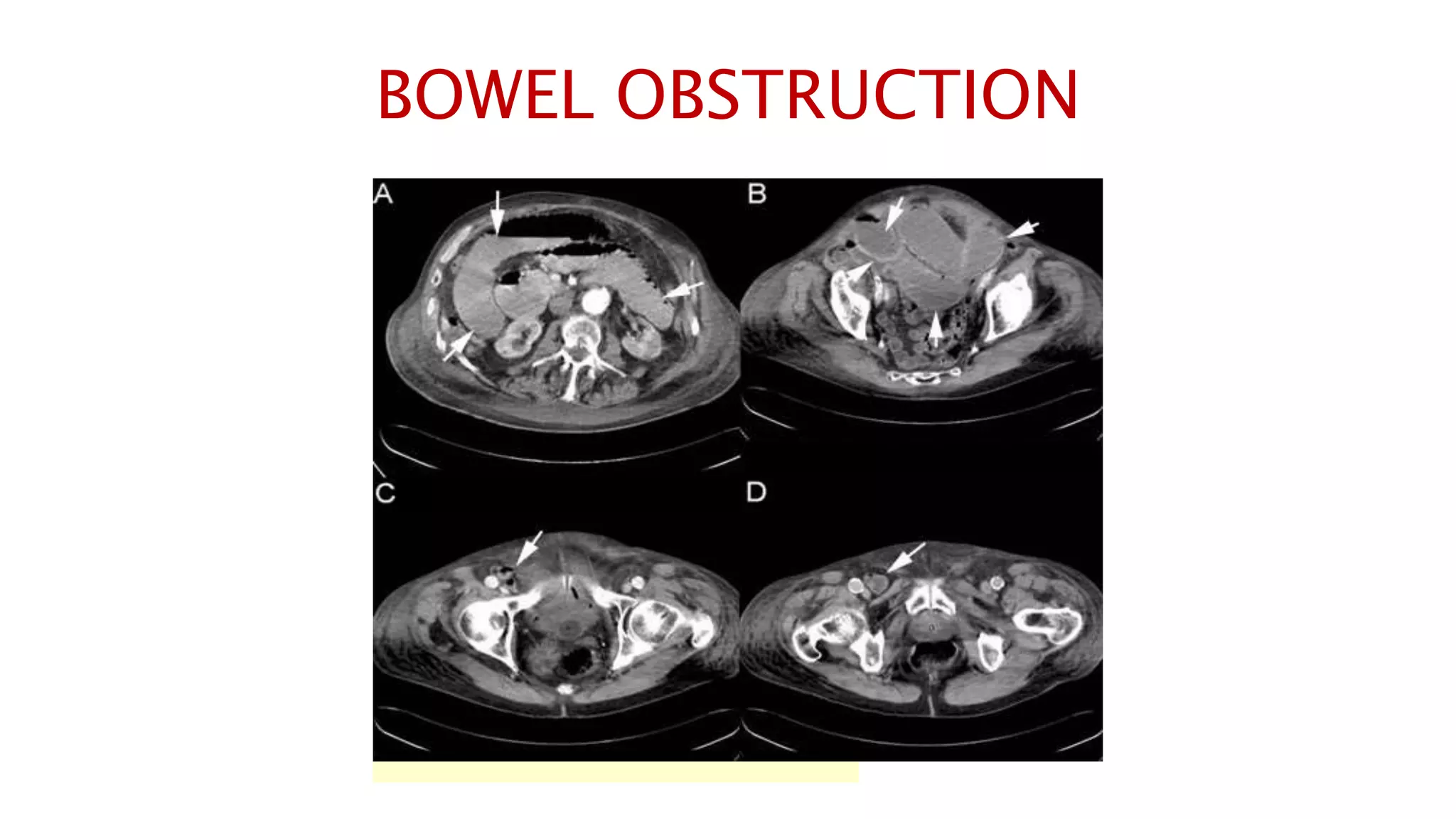 BOWEL OBSTRUCTION
 