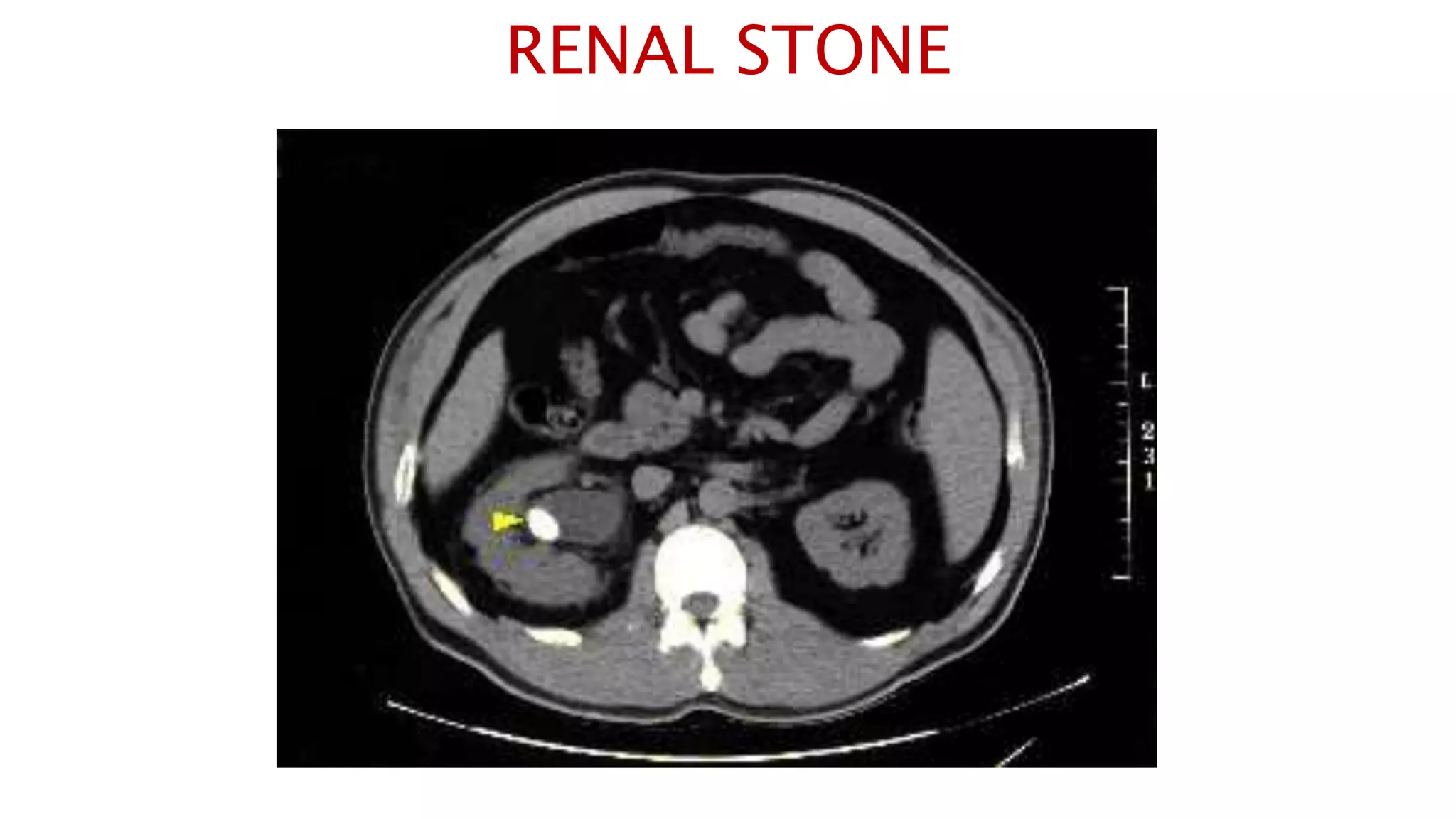 RENAL STONE
 
