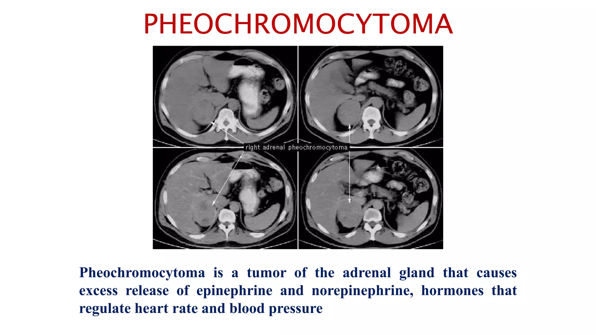 PHEOCHROMOCYTOMA
Pheochromocytoma is a tumor of the adrenal gland that causes
excess release of epinephrine and norepinephrine, hormones that
regulate heart rate and blood pressure
 