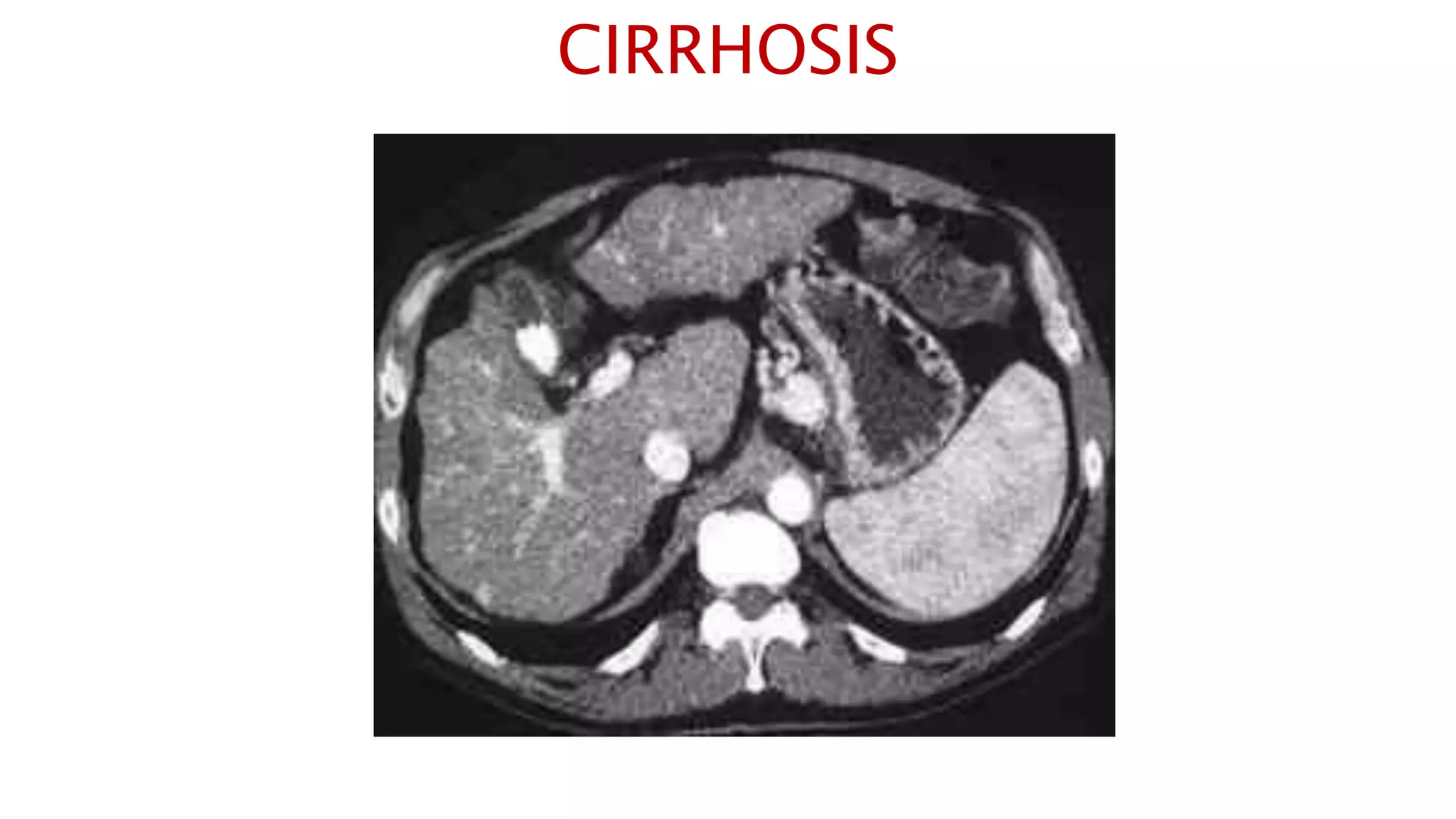 CIRRHOSIS
 
