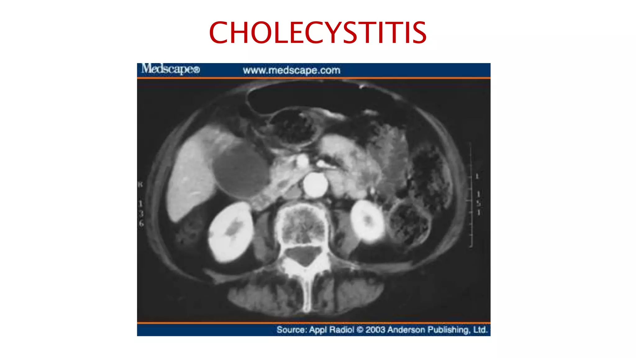 CHOLECYSTITIS
 