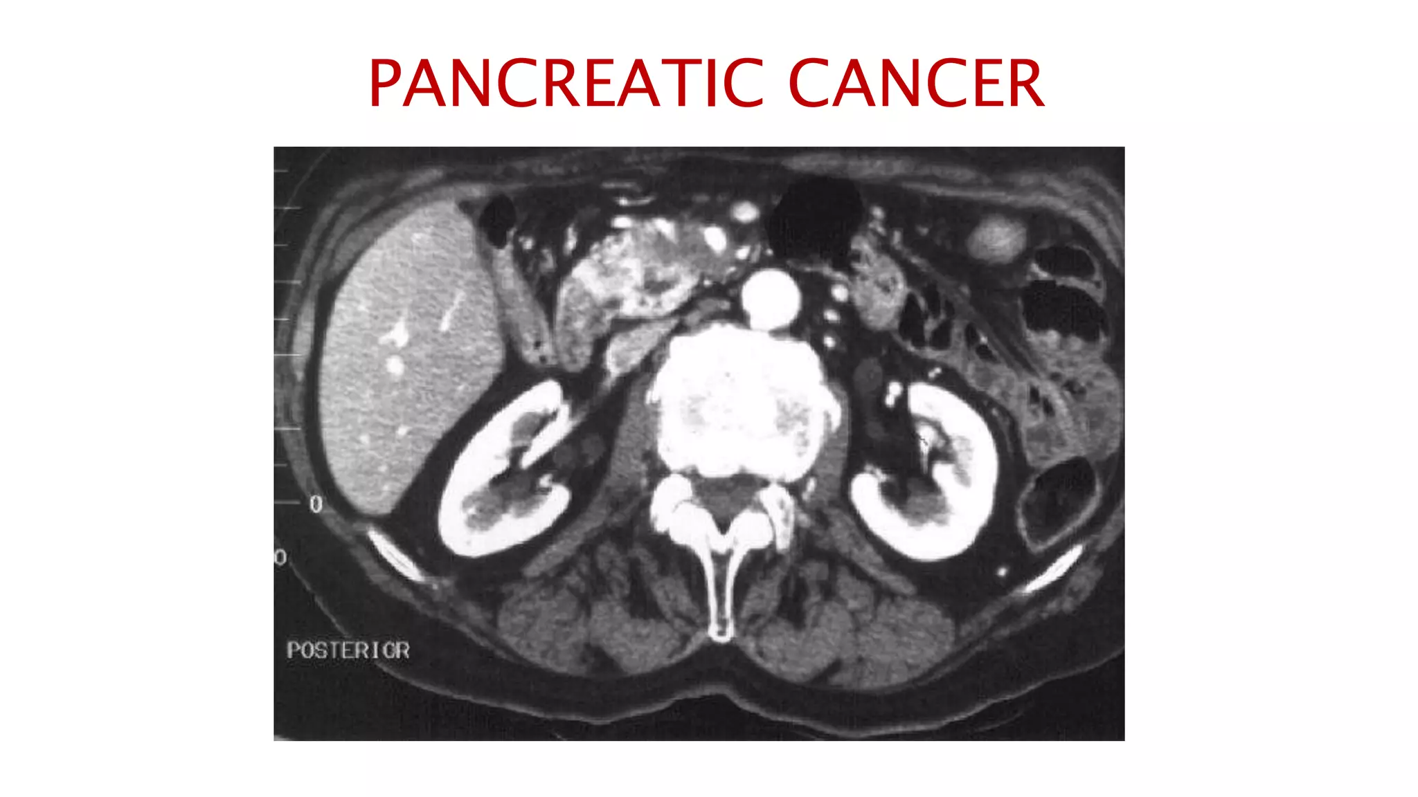 PANCREATIC CANCER
 