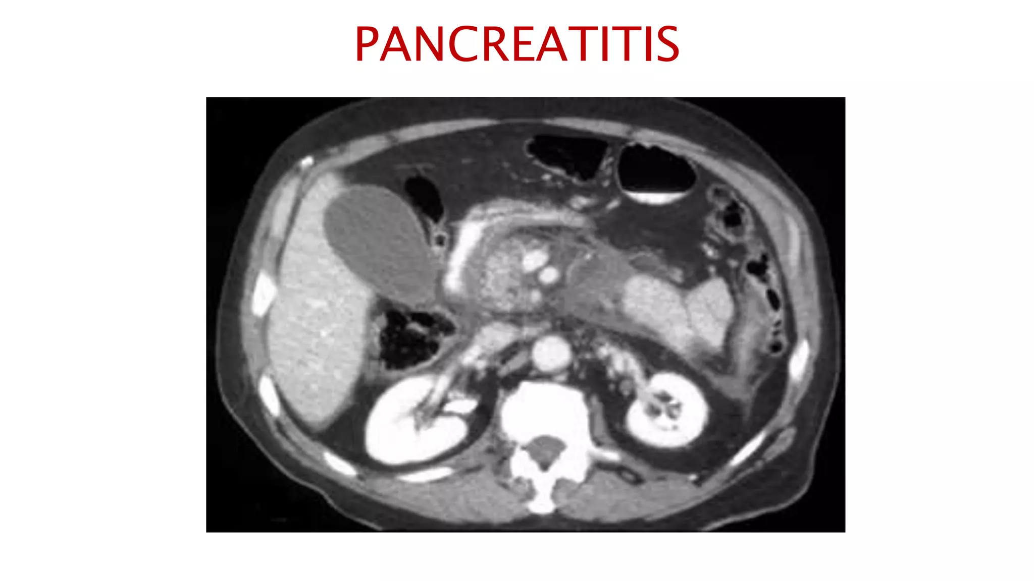 PANCREATITIS
 