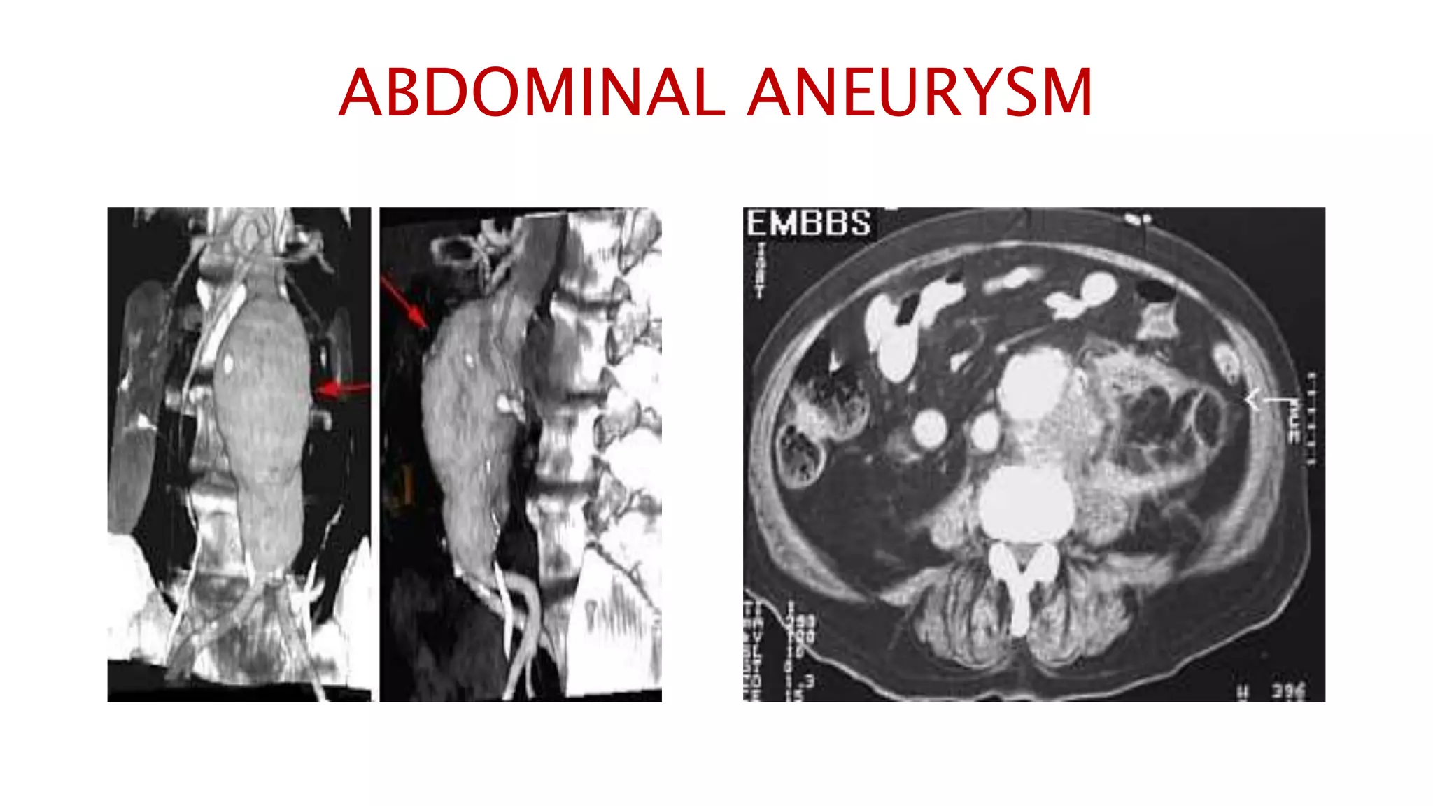 ABDOMINAL ANEURYSM
 