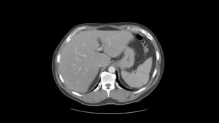 Abdominal CT scan | PPTX