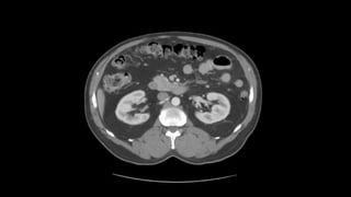 Abdominal CT scan | PPTX